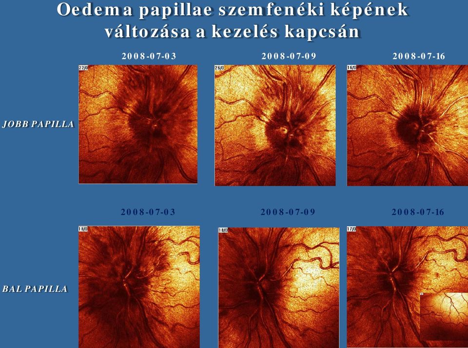 A bal szem 30% -os látása milyen cseppek kezelik a rövidlátást