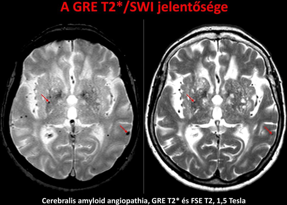 Cerebralis amyloid