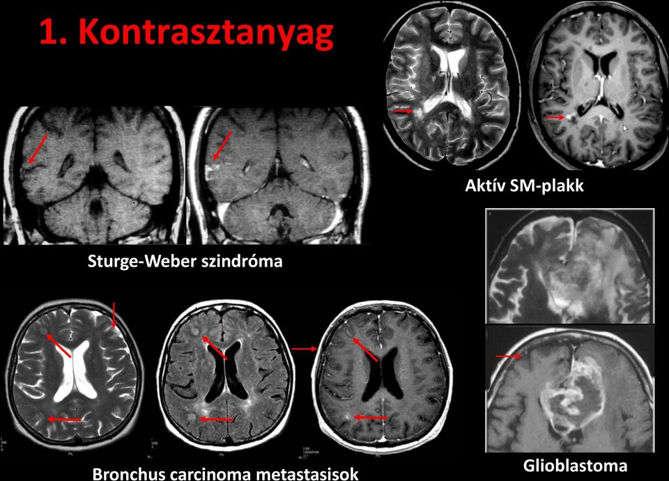 szindróma Bronchus