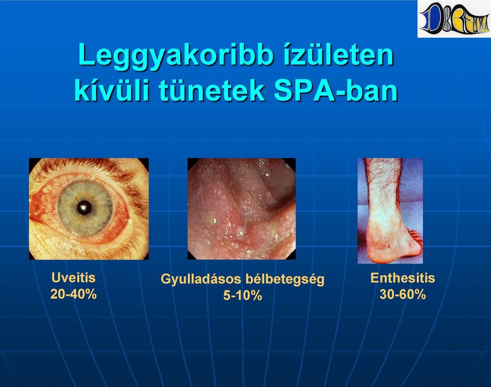 Uveitis 20-40% Gyulladásos