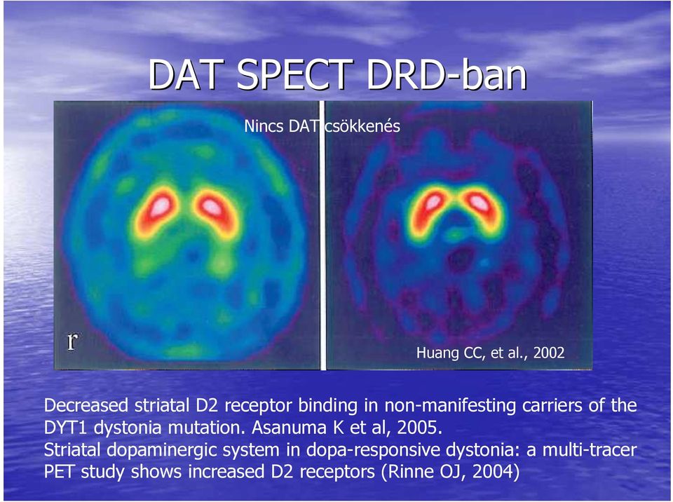 the DYT1 dystonia mutation. Asanuma K et al, 2005.