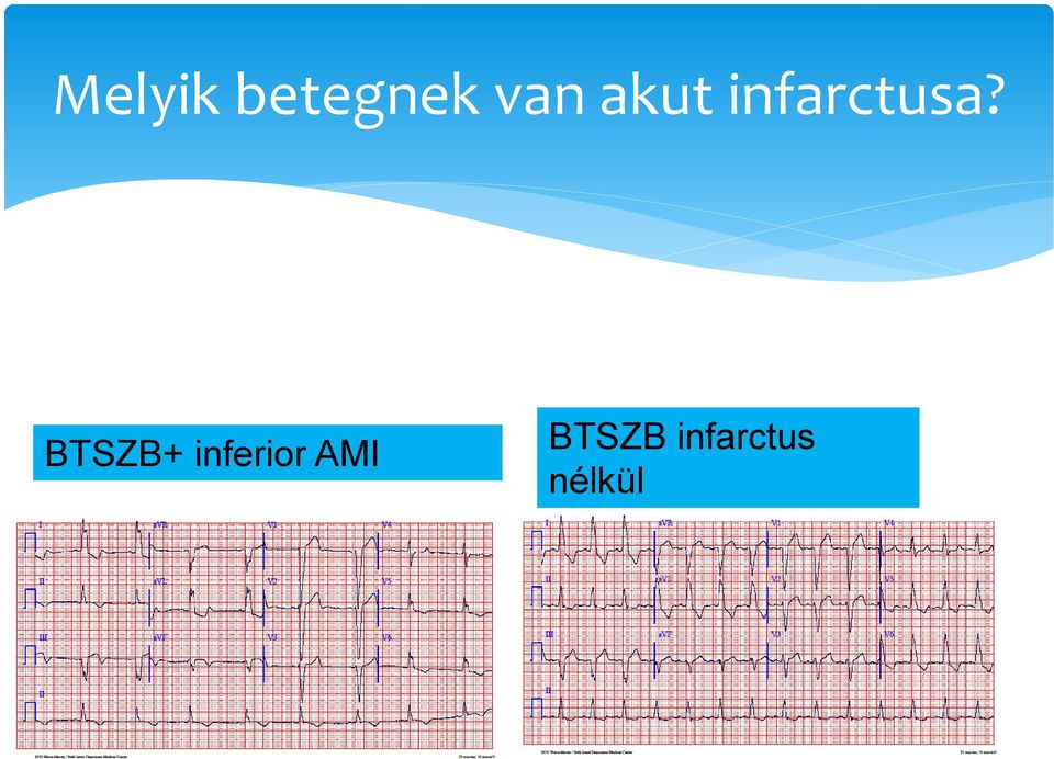 BTSZB+ inferior AMI