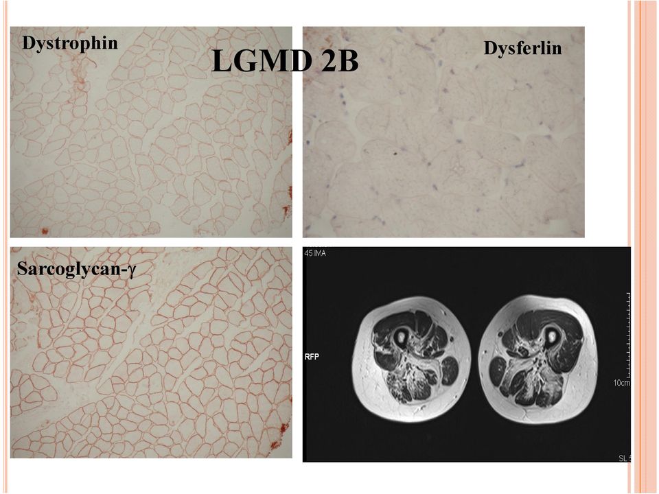 Dysferlin
