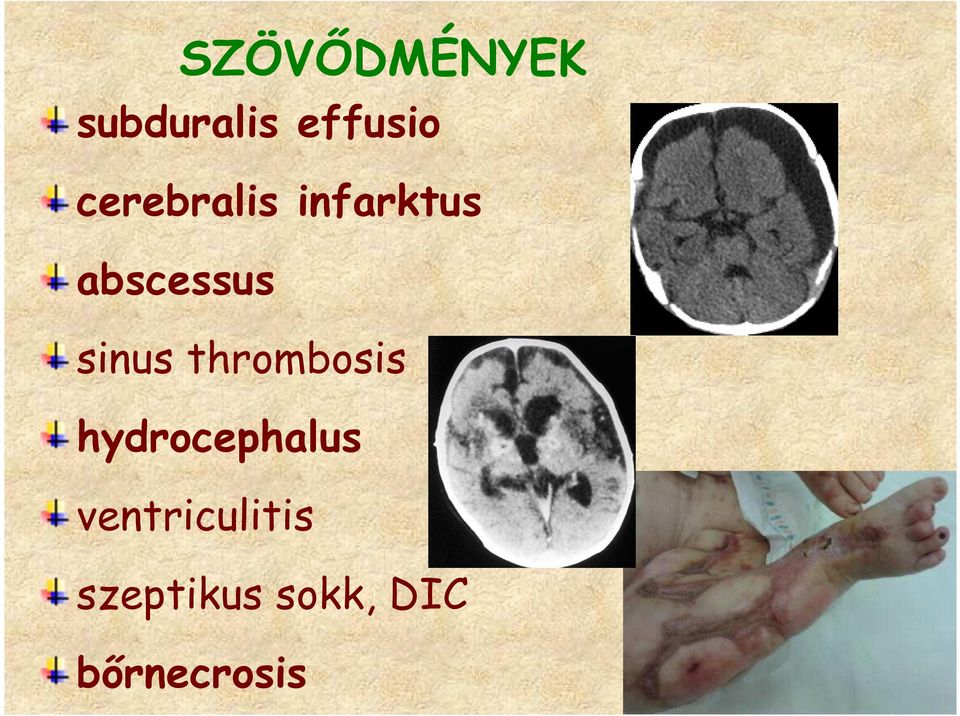 sinus thrombosis hydrocephalus