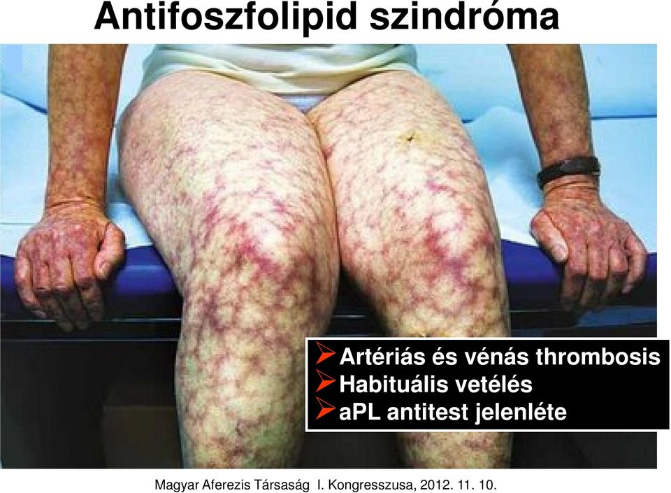 vénás thrombosis