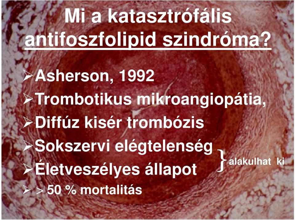 Diffúz kisér trombózis Sokszervi elégtelenség