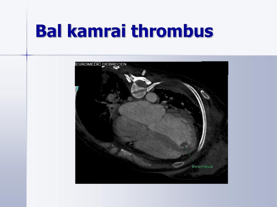 thrombus
