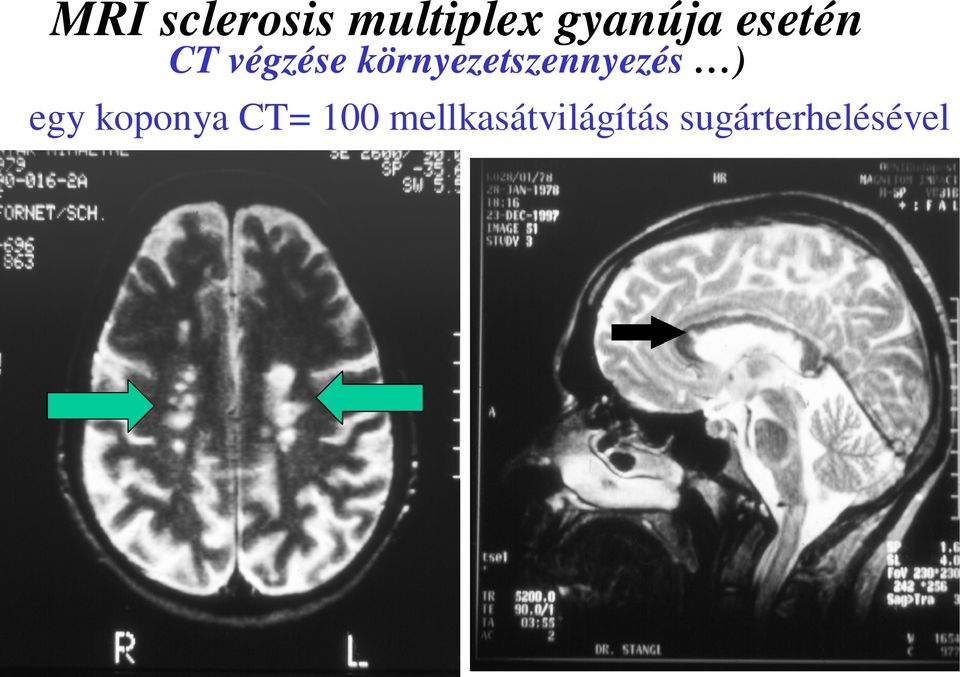 akaratlan fogyás sclerosis multiplex