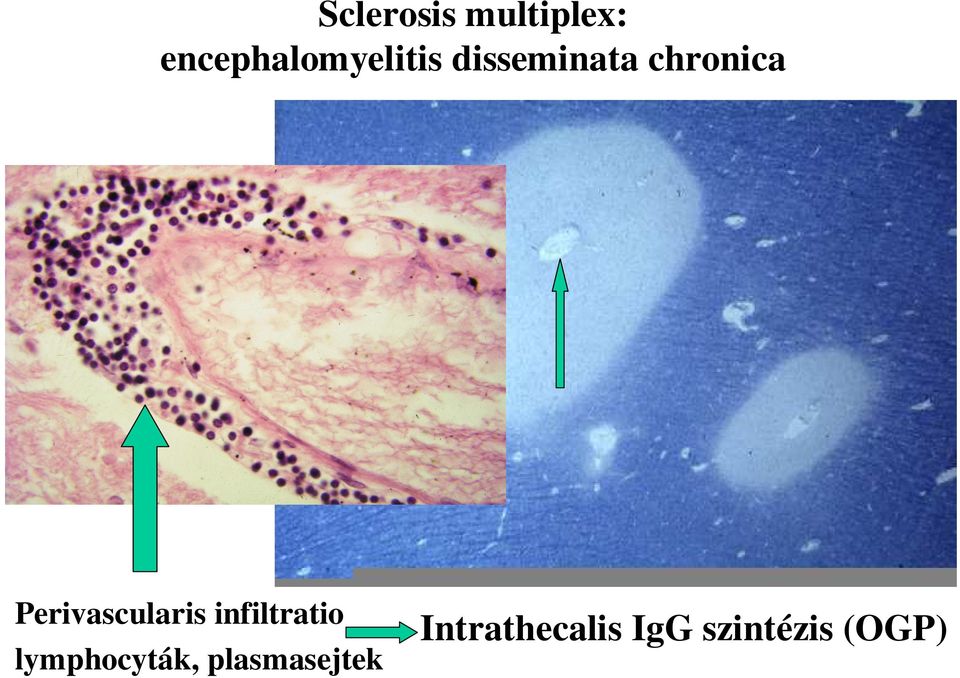 chronica Perivascularis infiltratio