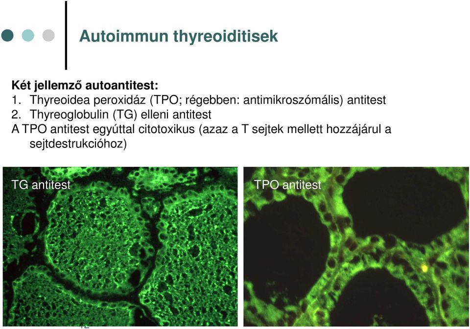 Thyreoglobulin (TG) elleni antitest A TPO antitest egyúttal