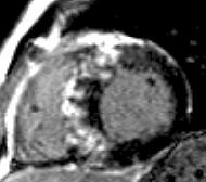 Seven years previously, a single Holter had shown 3 beats of NSVT. Cine CMR shows HCM with ASH, no SAM, no LVOTO (left or right), and normal systolic function.