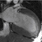 NONINVAZÍV VIZSGÁLATOK MRI: ~ echocardiographia; gold standard! szövettani tipizálás (hegszövet) therápia Case of the week: Number 06-02.