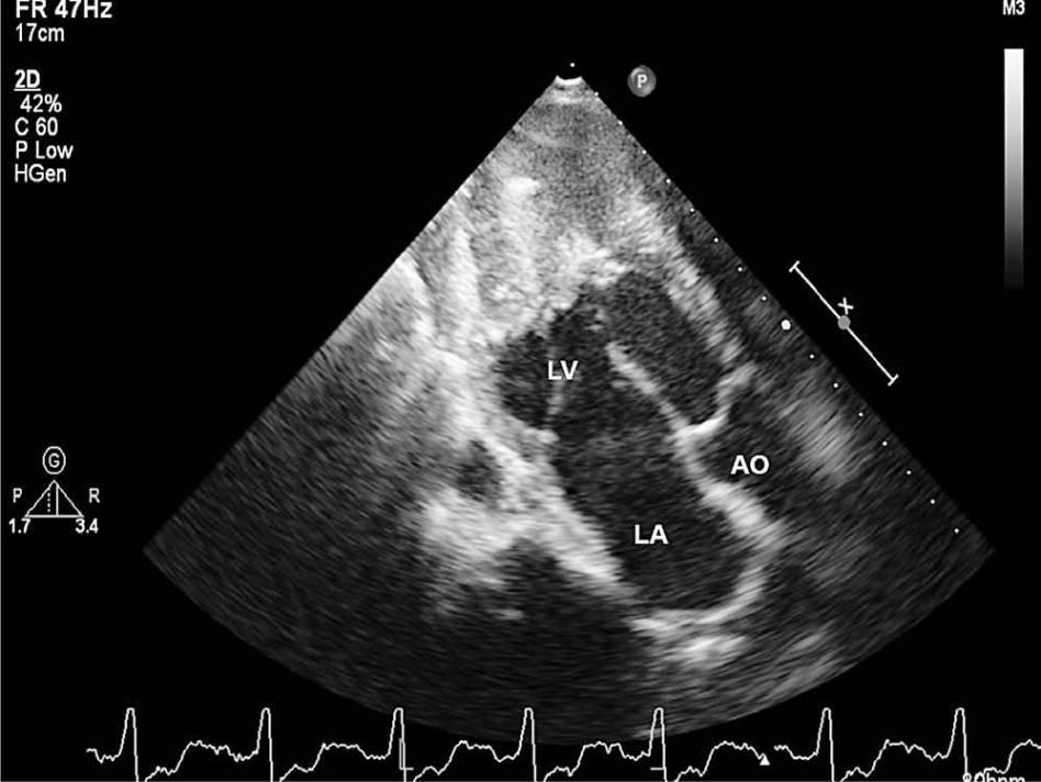Endomyocardiális fibrosis Primer hypereosinophilia-idiopathiás Secunder forma: tumorok, lymphomák, vasculitis, parazitás betegségek