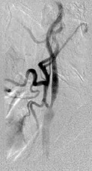 2. ábra. Az 1. beteg bal ACI preocclusiv stenosisának képe. Intracranialisan, vala mennyi éren durva kaliber ingadozást észleltünk.