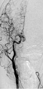 8. ábra. A 3. beteg bal ACI sztentelés és PTA utáni képe. 5. beteg: 53 éves férfibeteg anamnézisében instabil angina, AMI, pitvarfibrilláció szerepel.