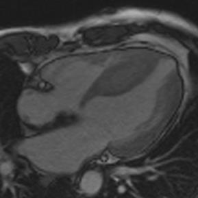 CMR-Cardiomyopathiák