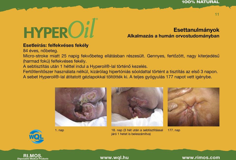 A sebtisztítás után 1 héttel indul a Hyperoil -lal történő kezelés.