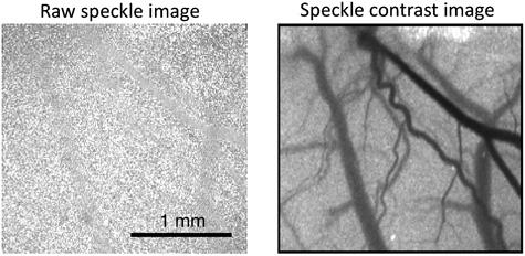 Lézeres folt-interferencia laser speckle