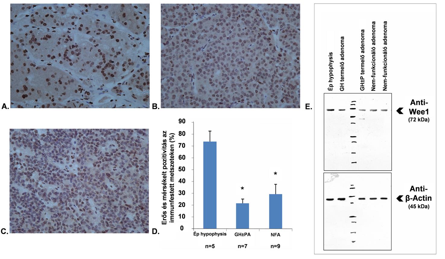 11. ábra. Normális hypophysis (A), GHA (B) és NFA szövetben (C) a Wee1 fehérje immunhisztokémiai vizsgálata.