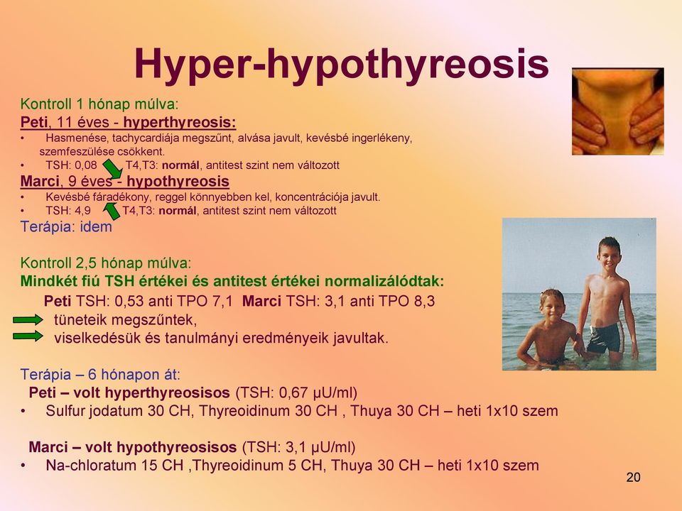 TSH: 4,9 T4,T3: normál, antitest szint nem változott Terápia: idem Kontroll 2,5 hónap múlva: Mindkét fiú TSH értékei és antitest értékei normalizálódtak: Peti TSH: 0,53 anti TPO 7,1 Marci TSH: 3,1
