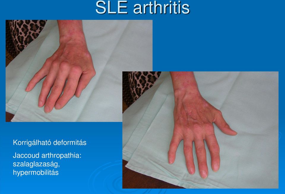 szisztémás kötőszöveti betegségek multiplex arthritis)