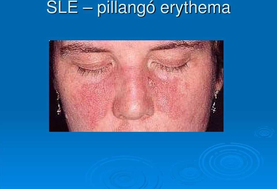 erythema