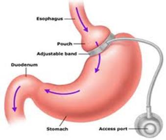 33. ábra A jejunoileális shunt Chandra Hassan: Metabolic surgery.ppt, Bariatric Surgery, St.