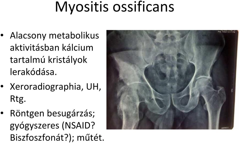 lerakódása. Xeroradiographia, UH, Rtg.