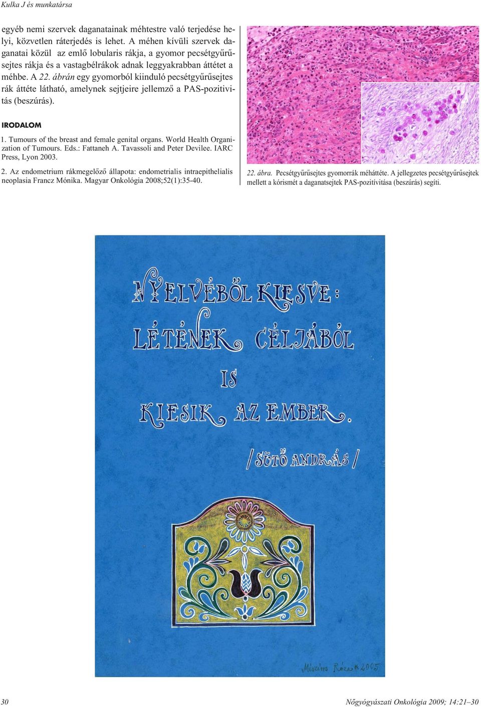 ábrán egy gyomorból kiinduló pecsétgyûrûsejtes rák áttéte látható, amelynek sejtjeire jellemzô a PAS-pozitivitás (beszúrás). IRODALOM 1. Tumours of the breast and female genital organs.