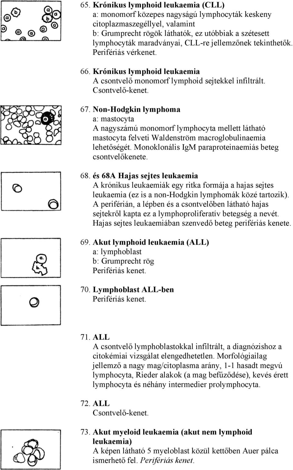 Non-Hodgkin lymphoma a: mastocyta A nagyszámú monomorf lymphocyta mellett látható mastocyta felveti Waldenström macroglobulinaemia lehetőségét.