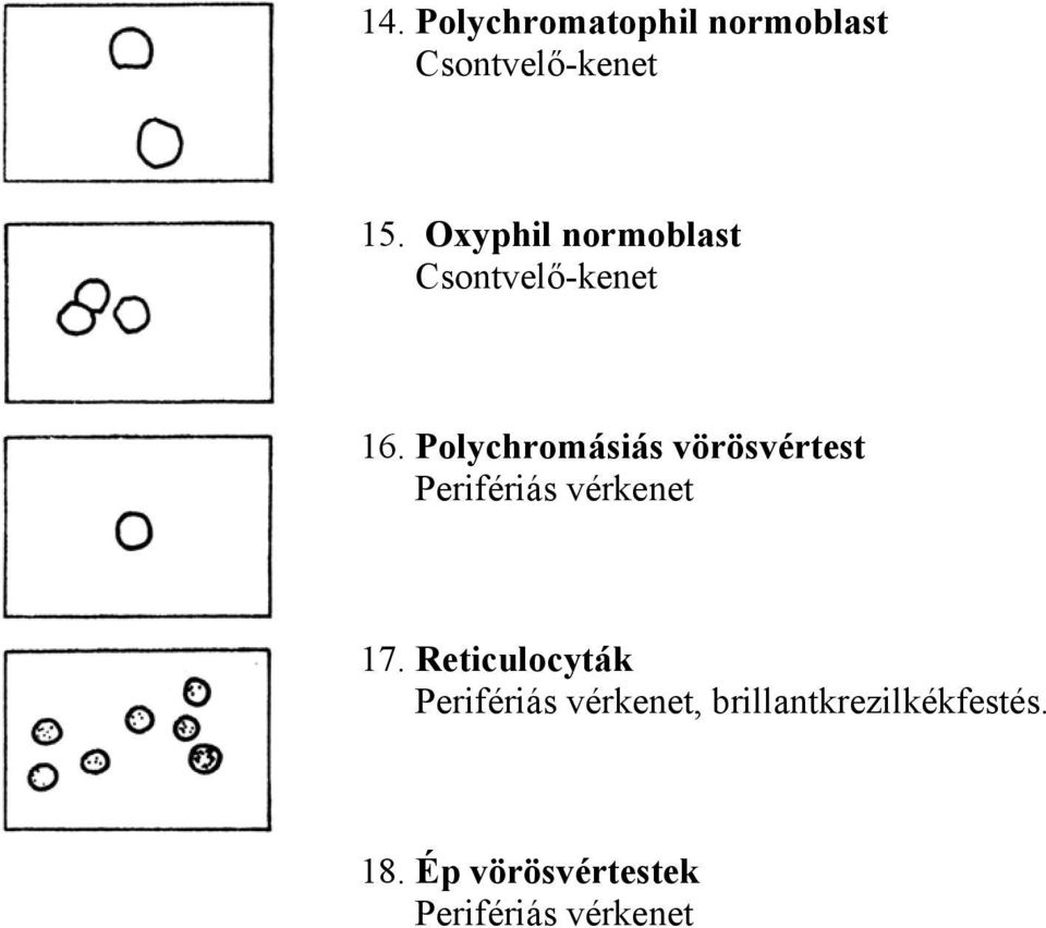 Polychromásiás vörösvértest Perifériás vérkenet 17.