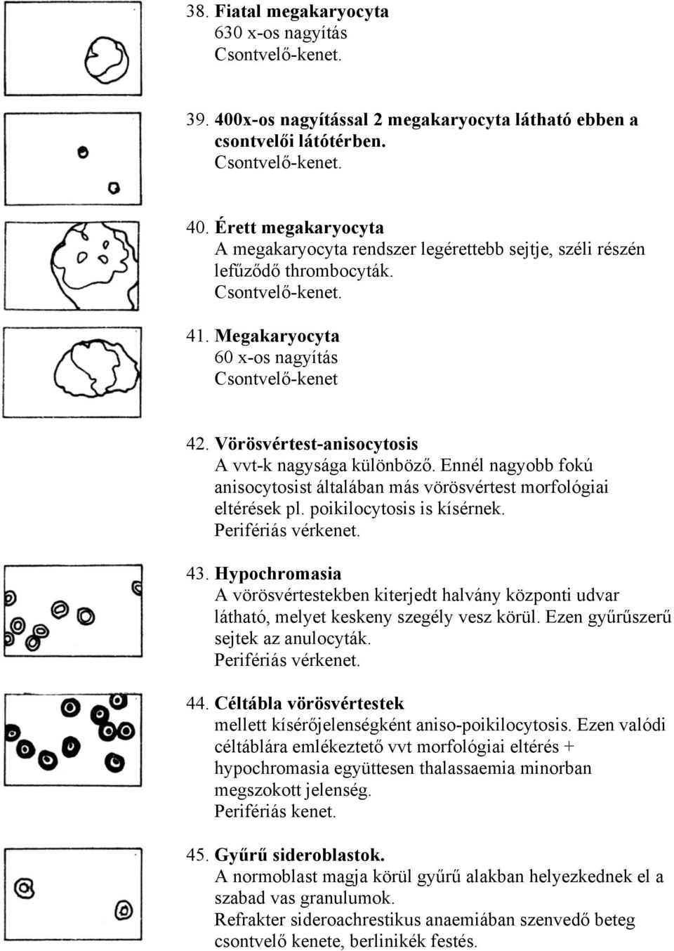 poikilocytosis is kísérnek. 43. Hypochromasia A vörösvértestekben kiterjedt halvány központi udvar látható, melyet keskeny szegély vesz körül. Ezen gyűrűszerű sejtek az anulocyták. 44.