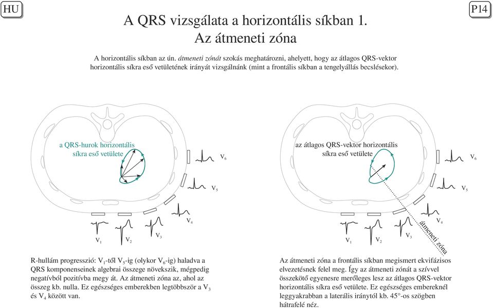 a QRS-hurok horizontális síkra eső vetülete V6 az átlagos QRS-vektor horizontális síkra eső vetülete V6 V5 V5 V2 V3 V1 V2 V3 na zó V1 V4 eti en átm V4 R-hullám progresszió: V1-től V5-ig (olykor