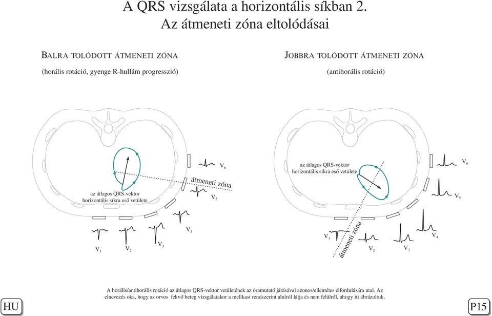 átmeneti az átlagos QRS-vektor horizontális síkra eső vetülete zóna V5 óna V5 V4 V1 V1 V2 V6 az átlagos QRS-vektor horizontális síkra eső vetülete V3 átm ene