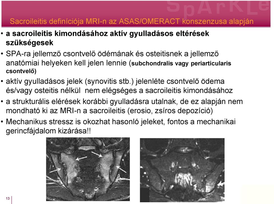 ) jelenléte csontvelő ödema és/vagy osteitis nélkül nem elégséges a sacroileitis kimondásához a strukturális elérések korábbi gyulladásra utalnak, de ez alapján