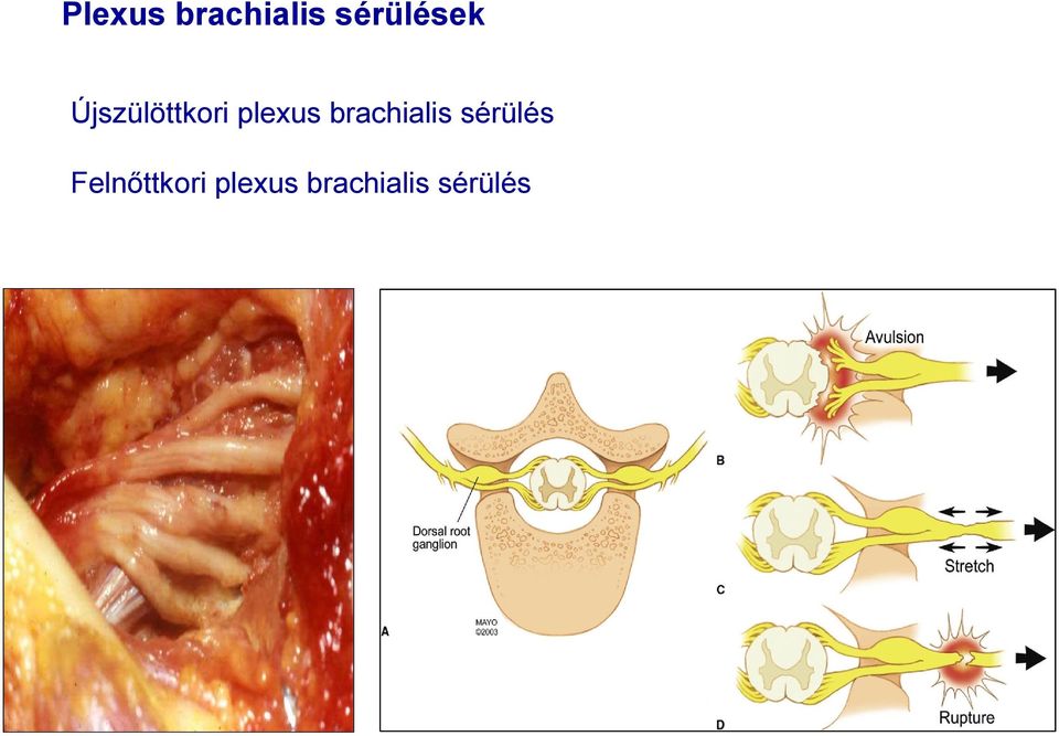 plexus brachialis sérülés
