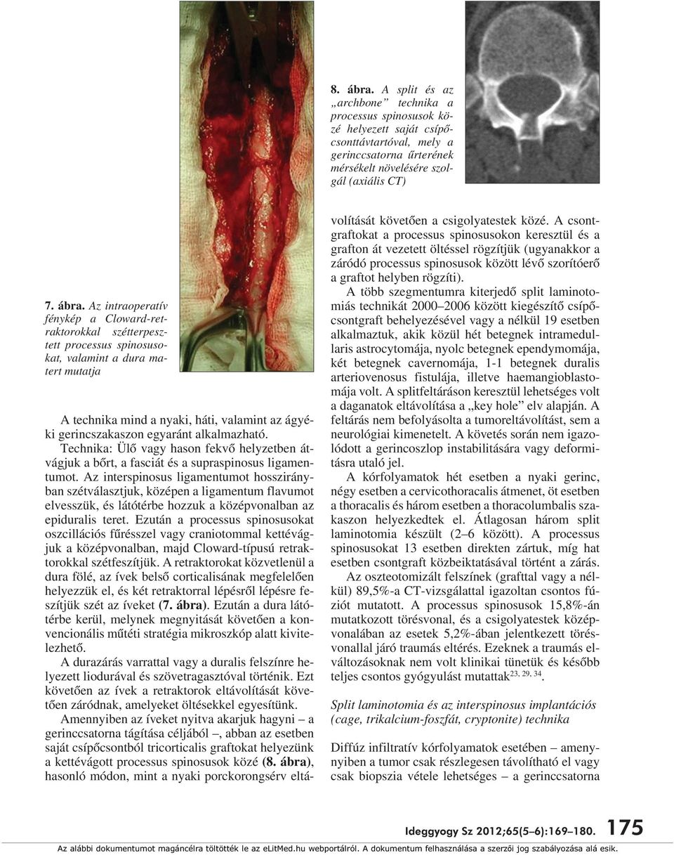 Az intraoperatív fénykép a Cloward-retraktorokkal szétterpesztett processus spinosusokat, valamint a dura matert mutatja A technika mind a nyaki, háti, valamint az ágyéki gerincszakaszon egyaránt