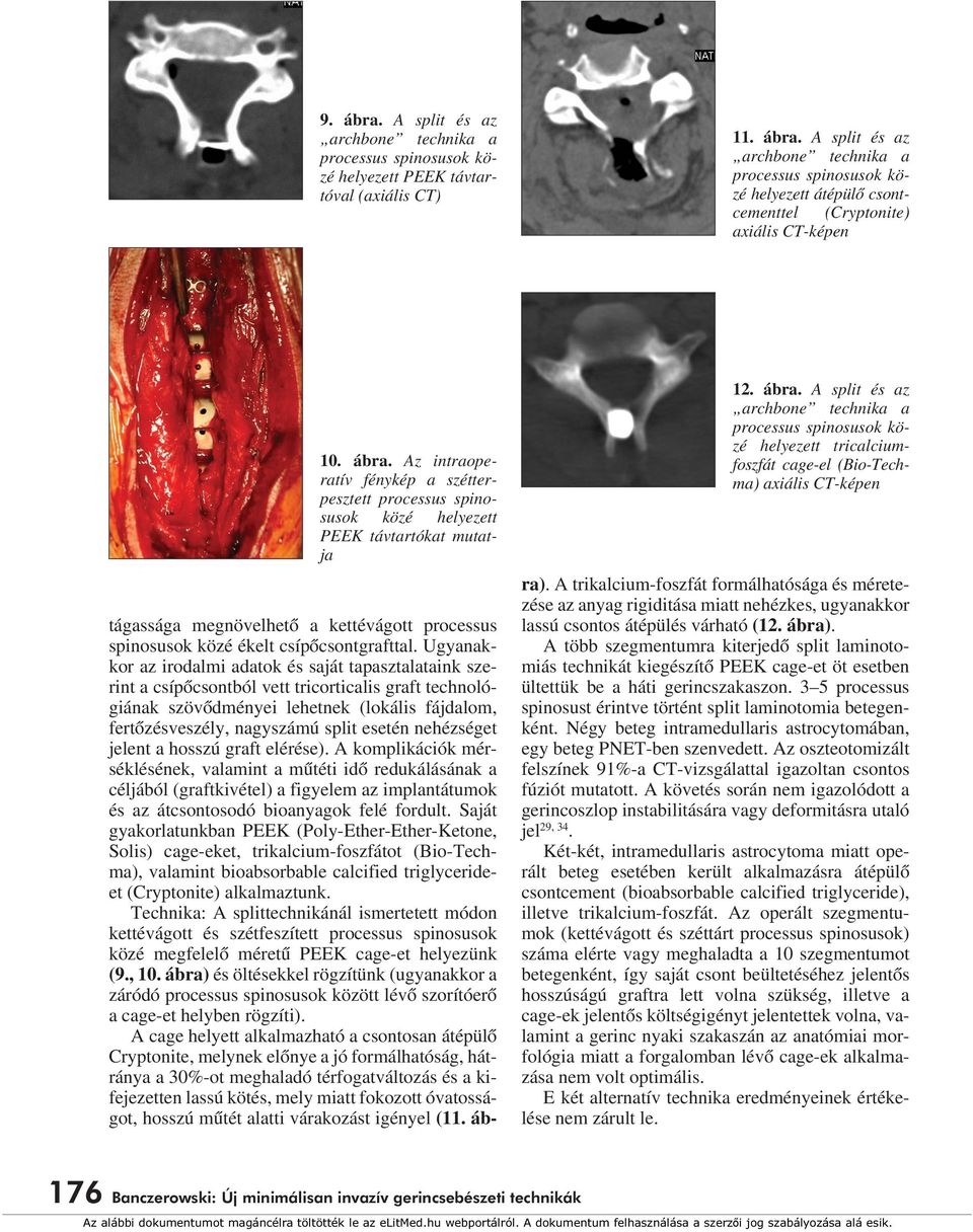 A split és az archbone technika a processus spinosusok közé helyezett tricalciumfoszfát cage-el (Bio-Techma) axiális CT-képen tágassága megnövelhetô a kettévágott processus spinosusok közé ékelt