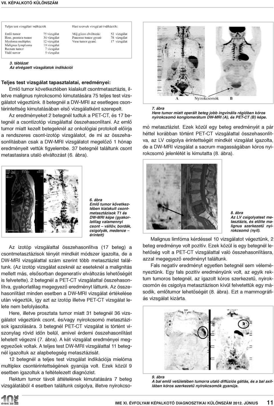 Az eredményeket 2 betegnél tudtuk a PET-CT, és 17 betegnél a csontizotóp vizsgálattal összehasonlítani.
