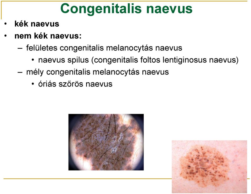 spilus (congenitalis foltos lentiginosus naevus)