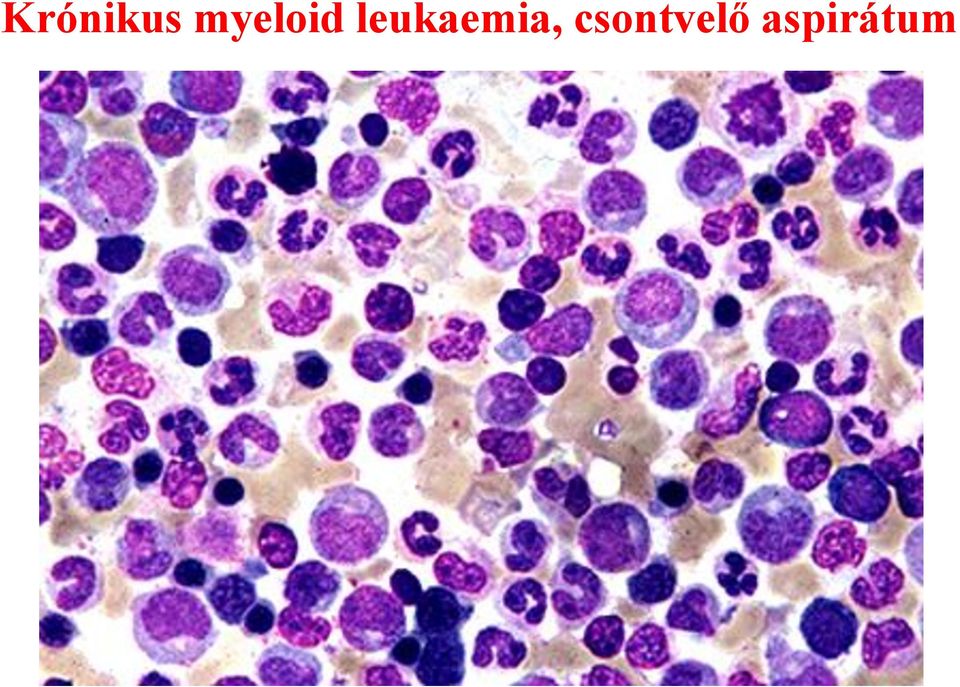 leukaemia,