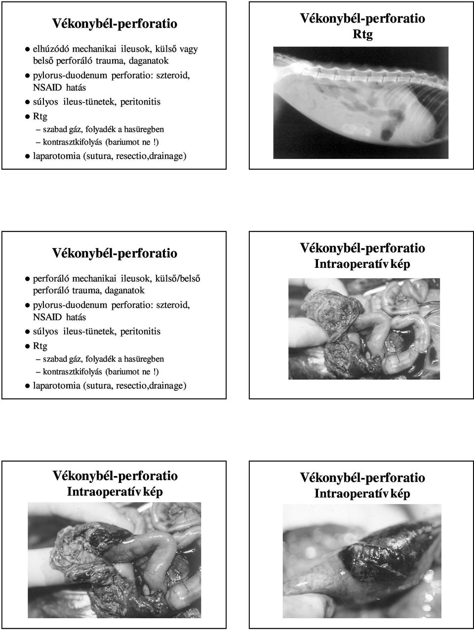 ) laparotomia (sutura, resectio,drainage) Vékonybél-perforatio Rtg Vékonybél-perforatio perforáló mechanikai ileusok, külső/belső perforáló trauma, daganatok