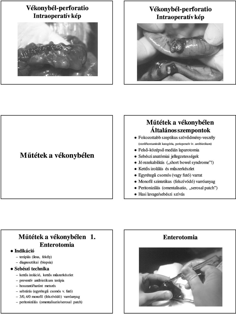 ) Kettős izolálás és műszerkészlet Egyrétegű csomós (vagy futó) varrat Monofil szintetikus (felszívódó) varróanyag Peritonizálás (omentalisatio, serosal patch ) Hasi lavage/sebészi szívás Műtétek a