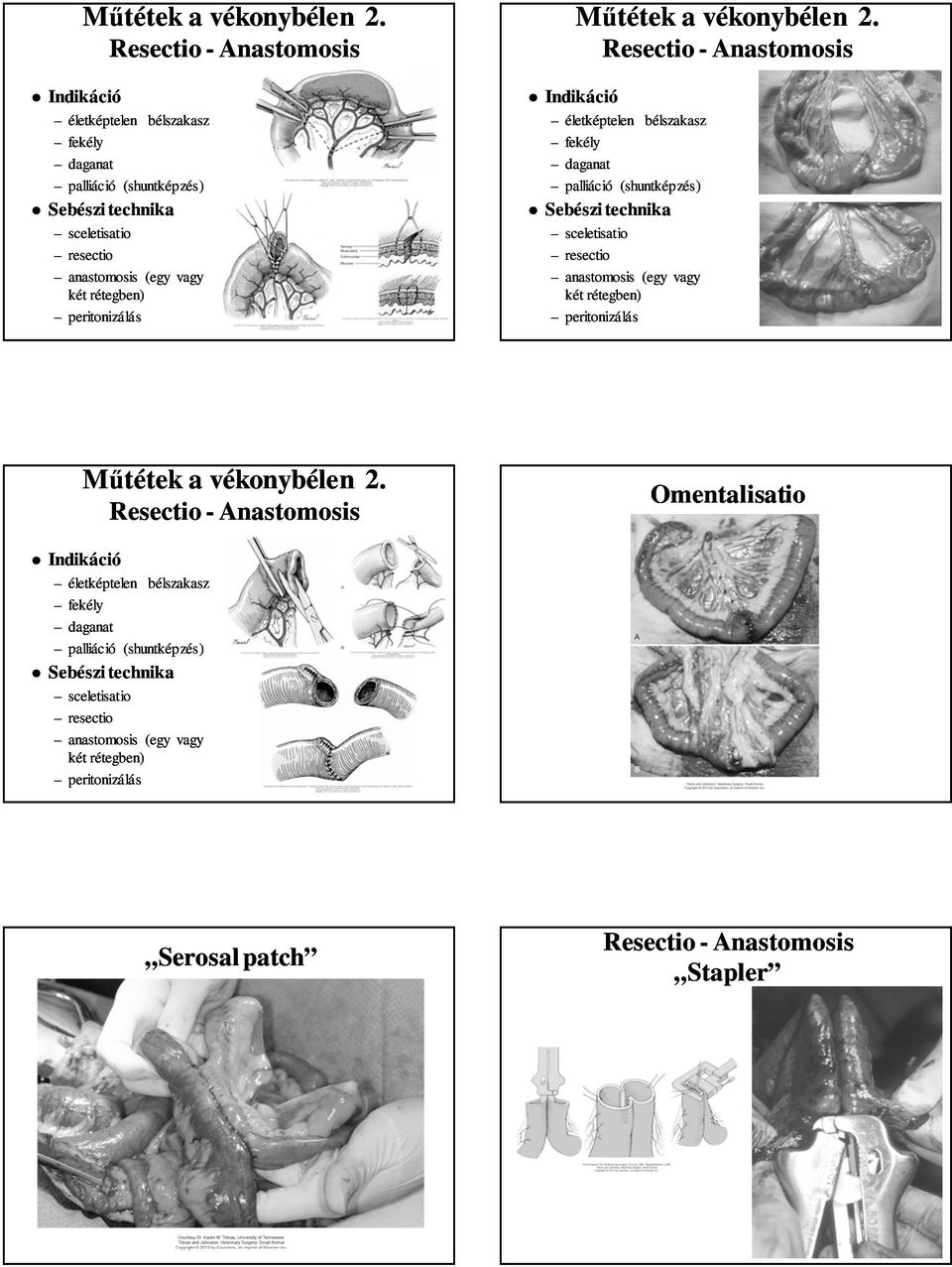 peritonizálás   peritonizálás  Resectio - Anastomosis Omentalisatio Indikáció életképtelen bélszakasz fekély daganat palliáció (shuntképzés) Sebészi technika sceletisatio