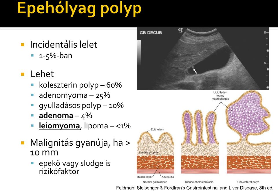 Malignitás gyanúja, ha > 10 mm epekő vagy sludge is rizikófaktor