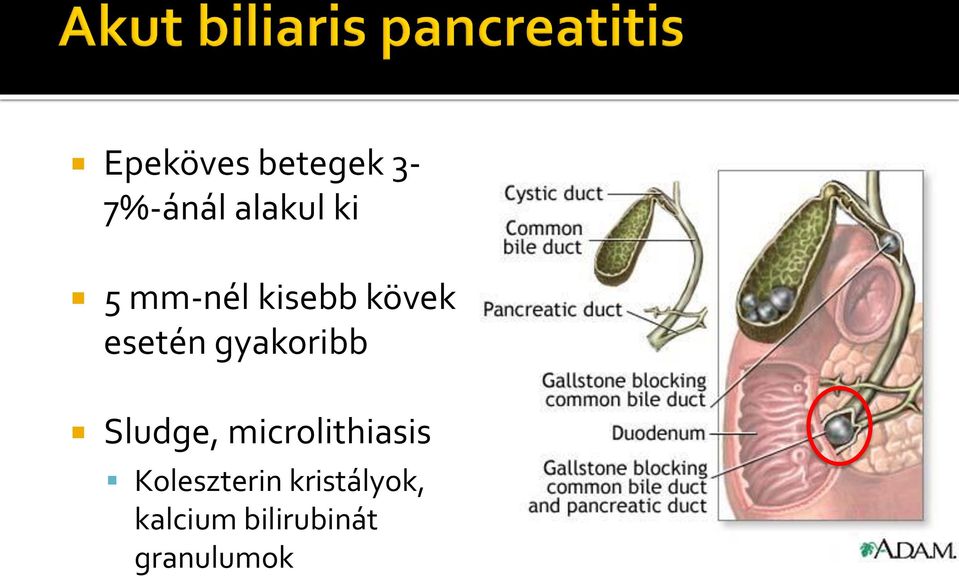 Sludge, microlithiasis Koleszterin