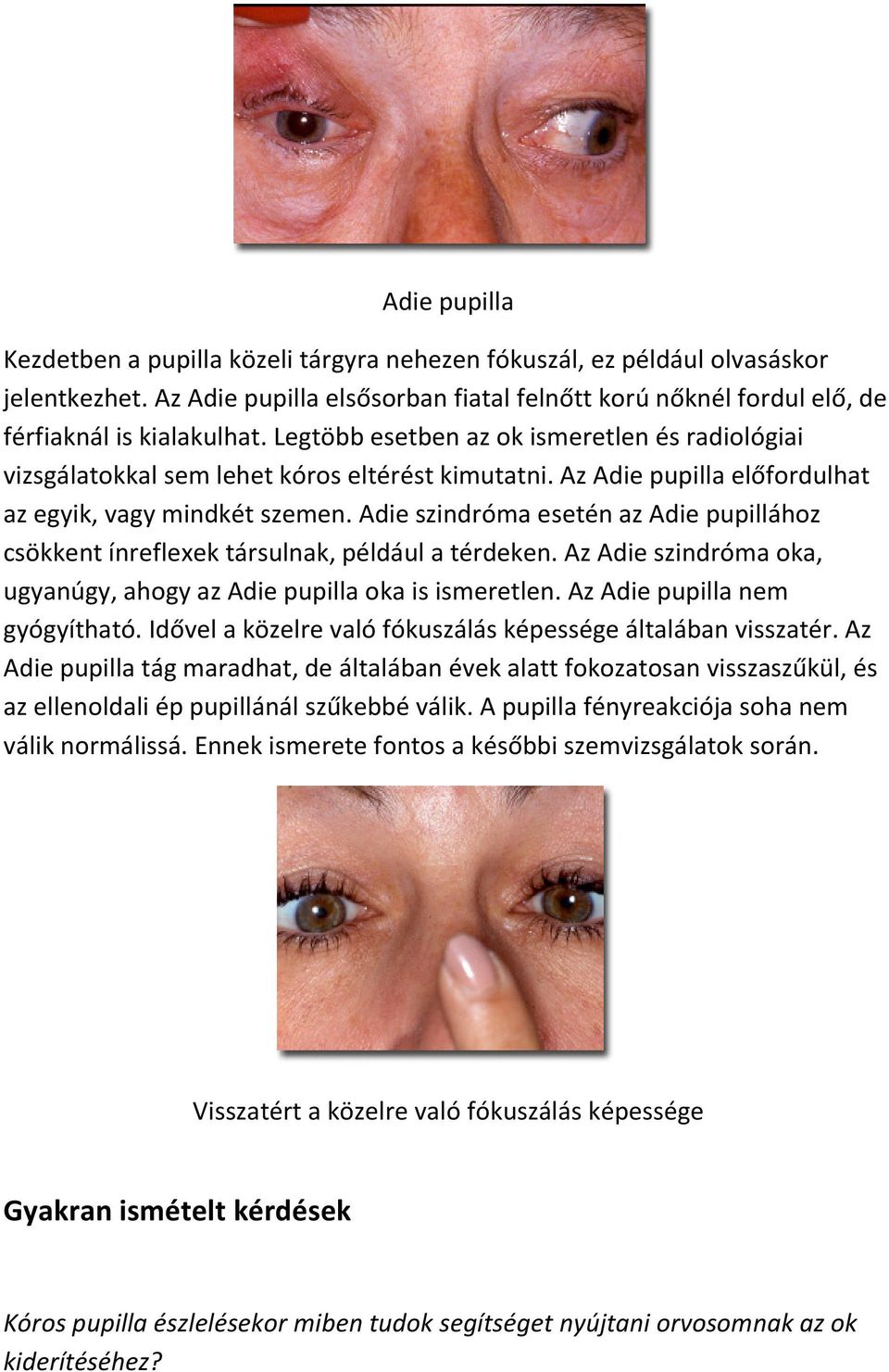 Adie szindróma esetén az Adie pupillához csökkent ínreflexek társulnak, például a térdeken. Az Adie szindróma oka, ugyanúgy, ahogy az Adie pupilla oka is ismeretlen. Az Adie pupilla nem gyógyítható.