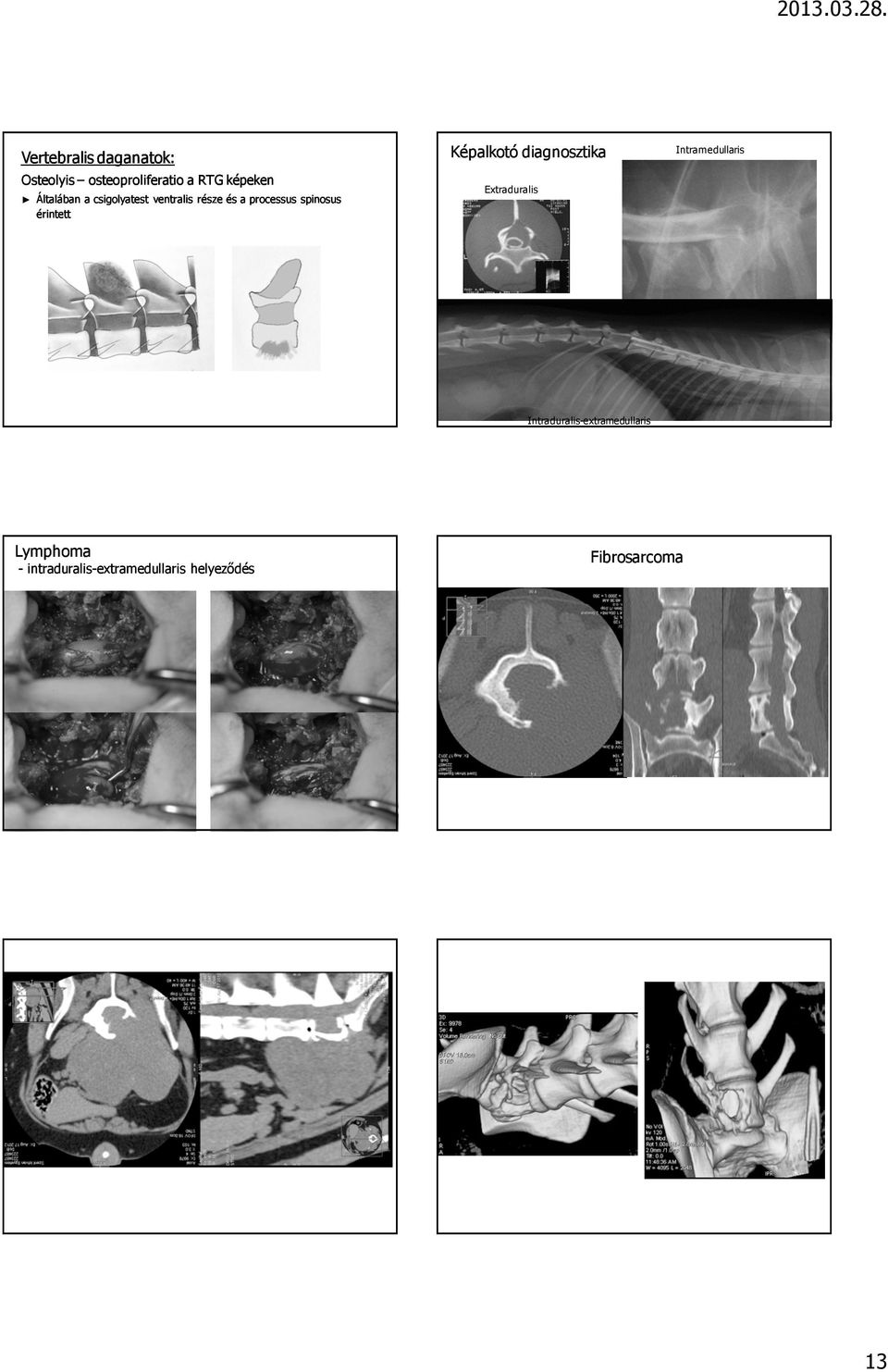 diagnosztika Extraduralis Intramedullaris Intraduralis-extramedullaris