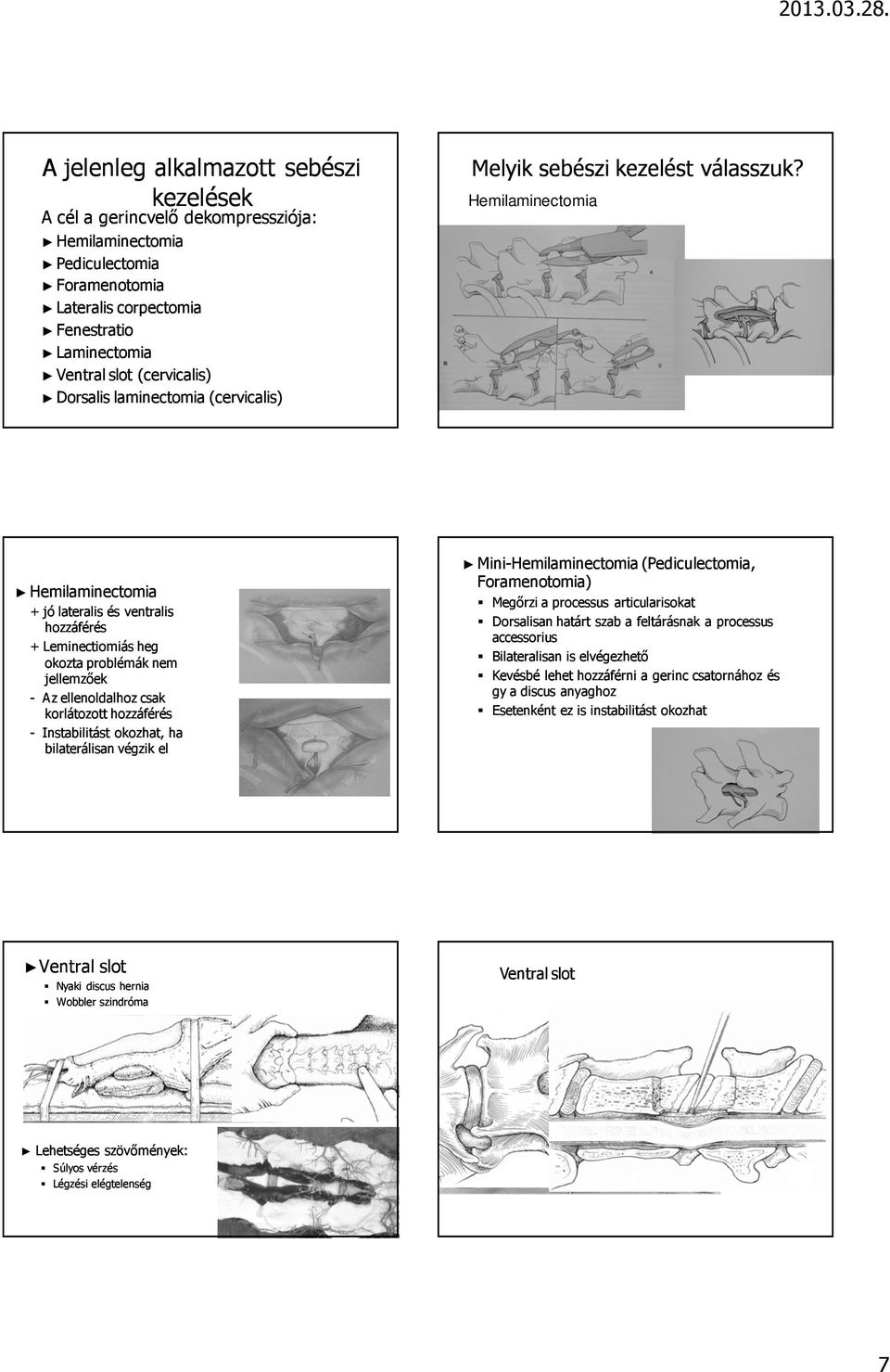 Hemilaminectomia Hemilaminectomiaia + jó lateralis és ventralis hozzáférés + Leminectiomiás heg okozta problémák nem jellemzıek - Az ellenoldalhoz csak korlátozott hozzáférés - Instabilitást tást