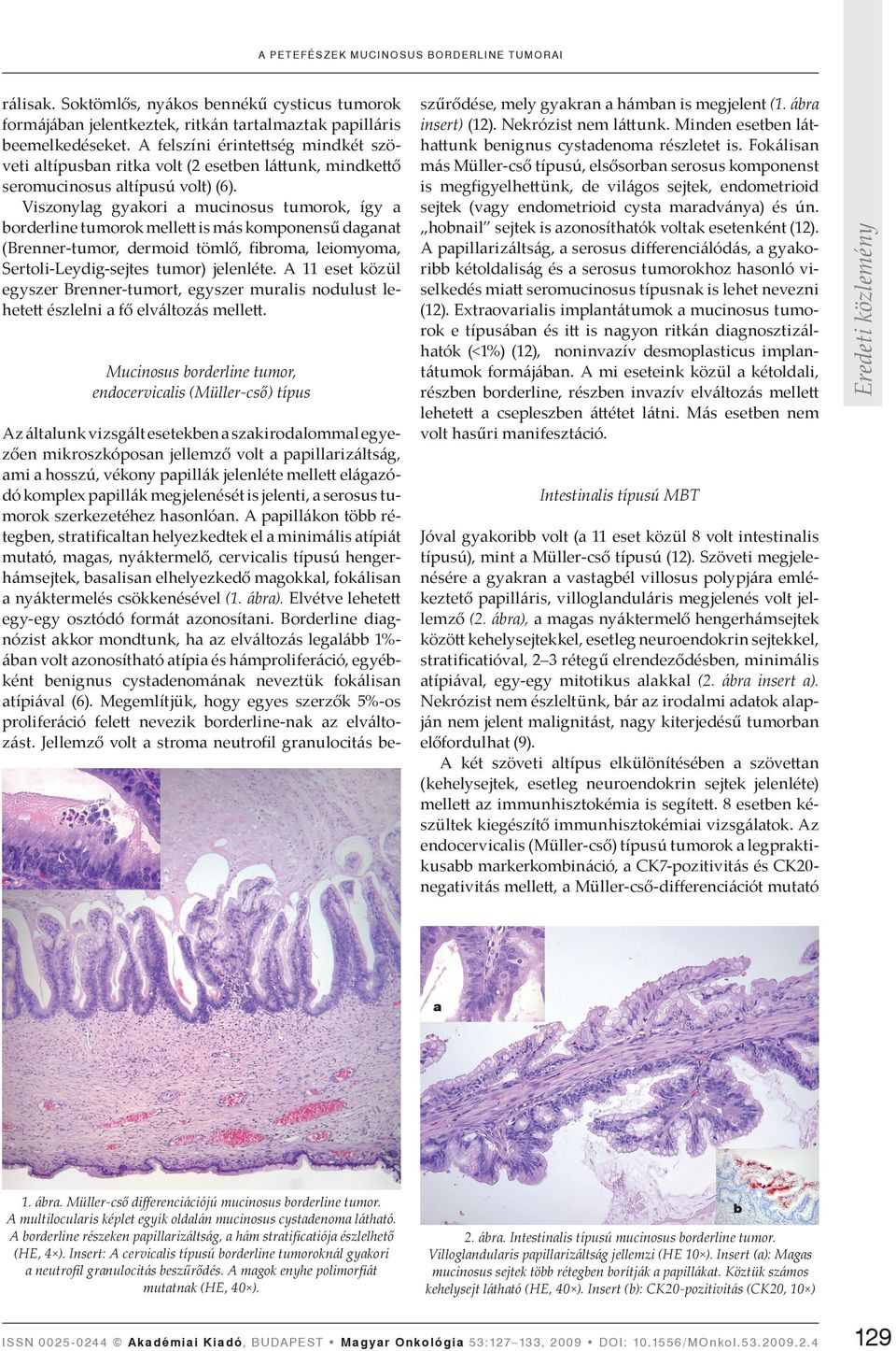 Viszonylag gyakori a mucinosus tumorok, így a borderline tumorok melle is más komponensű daganat (Brenner-tumor, dermoid tömlő, fibroma, leiomyoma, Sertoli-Leydig-sejtes tumor) jelenléte.